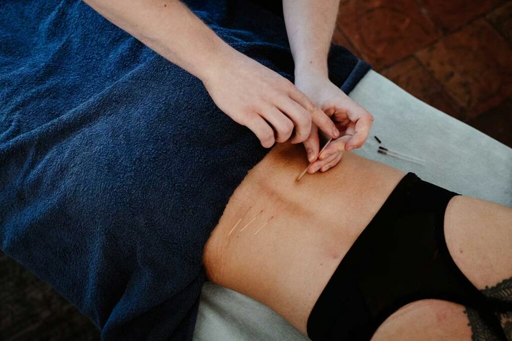 Acupuncture in Norwich